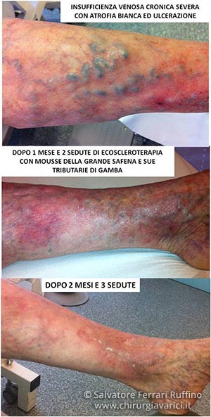 Scleroterapia per vene varicose